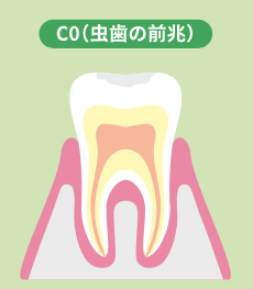 C0（虫歯の前兆）