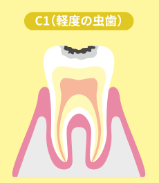 C1（軽度の虫歯）