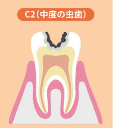 C2（中度の虫歯）