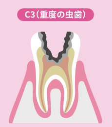 進行した虫歯(C3)