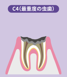 C4（最重度の虫歯）