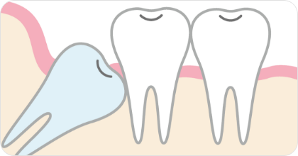 親知らずなどの抜歯