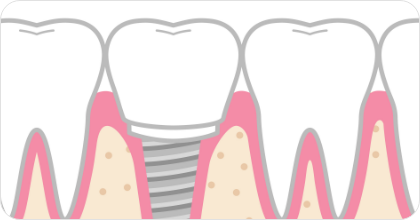インプラント